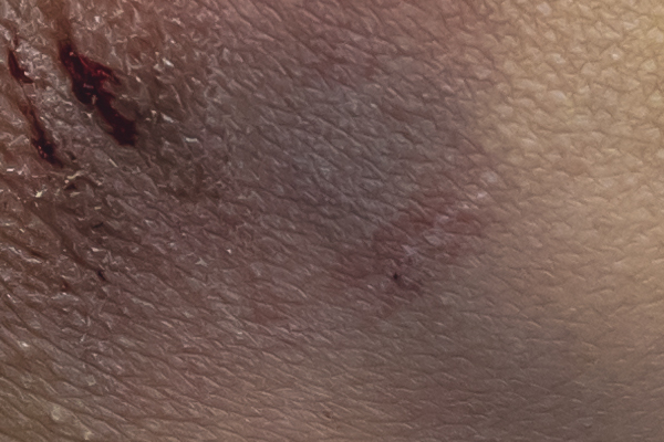 Dr. Pradhan Chetan Vijay | Dermatology | 34 + Years of Experience