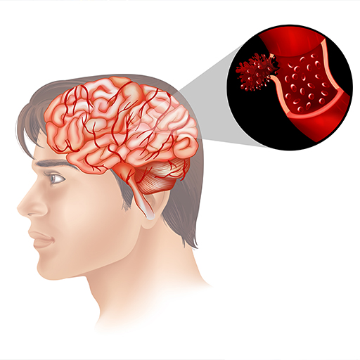 Vascular Neurology
